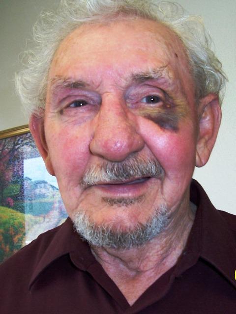 100_2776.JPG - I told Chet not to cross me or I'd give him a black eye!  (Actually, this is just a result of his cataract surgery!)